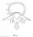 Fig. 22 - Method for delivering and positioning implants in the intervertebral disc environment