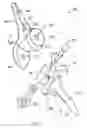 Fig. 09 - Modular total elbow prosthesis, humeral component and associated kit