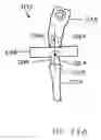 Fig. 31 - Modular total elbow prosthesis, humeral component and associated kit