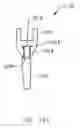 Fig. 33 - Modular total elbow prosthesis, humeral component and associated kit