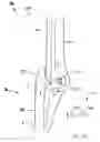 Fig. 43 - Modular total elbow prosthesis, humeral component and associated kit