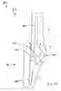 Fig. 44 - Modular total elbow prosthesis, humeral component and associated kit