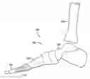 Fig. 01 - Method and system for toe arthroplasty
