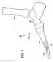 Fig. 02 - Method and system for toe arthroplasty