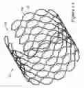 Fig. 02 - Tubular stent and methods of making the same