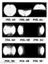 Fig. 04 - Iterative decomposition of water and fat with echo asymmetry and least square estimation