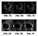 Fig. 07 - Iterative decomposition of water and fat with echo asymmetry and least square estimation