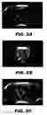 Fig. 08 - Iterative decomposition of water and fat with echo asymmetry and least square estimation