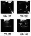 Fig. 10 - Iterative decomposition of water and fat with echo asymmetry and least square estimation