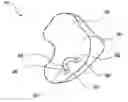 Fig. 01 - Retainable hearing aid and method thereof
