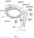 Fig. 02 - Method for preventing nasolacrimal duct obstruction