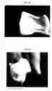 Fig. 04 - Muscle-based grafts/implants
