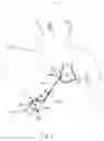 Fig. 03 - Method and apparatus for treatment of cardiac disorders