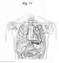 Fig. 22 - Arrhythmia discrimination using electrocardiograms sensed from multiple implanted electrodes