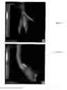 Fig. 10 - Soft-flow aortic cannula tip