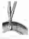 Fig. 11 - Soft-flow aortic cannula tip