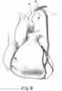 Fig. 08 - Diagnostic catheter and its method of application