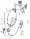 Fig. 03 - Medical needles for damping motion