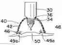 Fig. 01 - Wound protection and therapy system