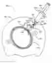 Fig. 01 - Method and apparatus for facilitating evacuation and cleansing of a colonostomy bag