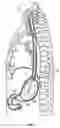 Fig. 03 - Method for gastric cooling using balloon catheter