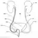 Fig. 01 - Non-expandable transluminal access sheath