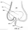 Fig. 09 - Non-expandable transluminal access sheath