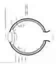 Fig. 07 - Methods for treating hyperopia and presbyopia via laser tunneling