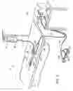 Fig. 02 - Systems and methods for electrosurgical treatment of obstructive sleep disorders