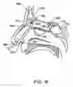 Fig. 22 - Systems and methods for electrosurgical treatment of obstructive sleep disorders