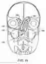 Fig. 23 - Systems and methods for electrosurgical treatment of obstructive sleep disorders
