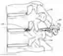 Fig. 01 - Minimally invasive method for delivery and positioning of intervertebral disc implants