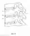 Fig. 13 - Minimally invasive method for delivery and positioning of intervertebral disc implants