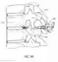 Fig. 14 - Minimally invasive method for delivery and positioning of intervertebral disc implants