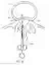 Fig. 15 - Minimally invasive method for delivery and positioning of intervertebral disc implants