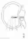 Fig. 17 - Minimally invasive method for delivery and positioning of intervertebral disc implants