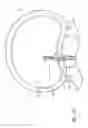 Fig. 18 - Minimally invasive method for delivery and positioning of intervertebral disc implants