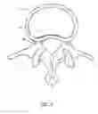 Fig. 22 - Minimally invasive method for delivery and positioning of intervertebral disc implants