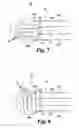 Fig. 04 - Method of preparing an implant for delivery into a vertebral space
