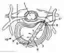 Fig. 01 - System and devices for the repair of a vertebral disc defect
