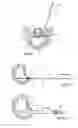 Fig. 09 - System and devices for the repair of a vertebral disc defect