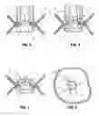Fig. 05 - Endoluminal gastric ring and method