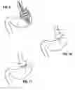 Fig. 06 - Endoluminal gastric ring and method