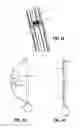 Fig. 13 - Endoluminal gastric ring and method