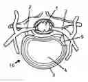 Fig. 01 - System and devices for the repair of a vertebral disc defect