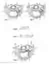 Fig. 03 - System and devices for the repair of a vertebral disc defect