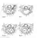 Fig. 06 - System and devices for the repair of a vertebral disc defect