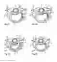 Fig. 08 - System and devices for the repair of a vertebral disc defect