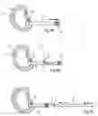 Fig. 12 - System and devices for the repair of a vertebral disc defect