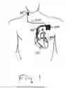 Fig. 02 - Method and device for comprehensive anti-tachyarrhythmia therapy